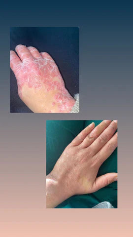 Psoriasis & Ekzem Probesalbe
